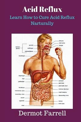 Acid Reflux: Learn How to Cure Acid Reflux Naturally Paperback Createspace Independent Publishing Platform