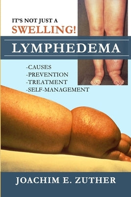 It's Not Just a Swelling! Lymphedema: Causes, Prevention, Treatment, Self-Management Paperback Lulu.com