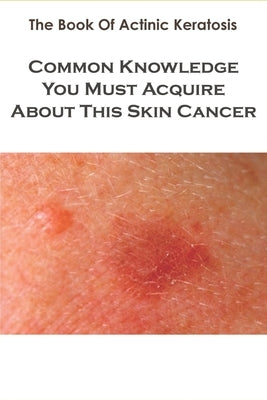The Book Of Actinic Keratosis_ Common Knowledge You Must Acquire About This Skin Cancer: Skin Cancer Books Paperback Independently Published
