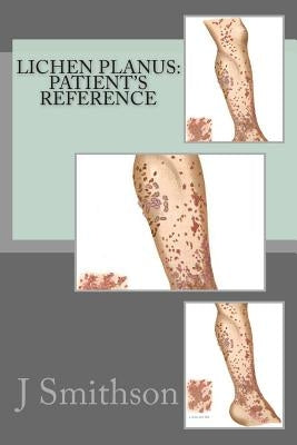 Lichen Planus: Patient's Reference by Smithson Ma, J. P.