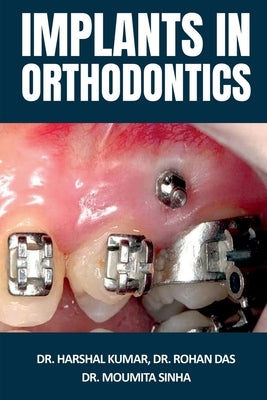 Implants in Orthodontics Paperback Notion Press