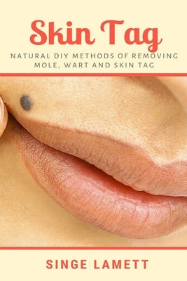 Skin Tag: Natural DIY Methods of removing Mole, Wart and Skin Tag by Lamett, Singe