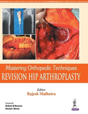 Mastering Orthopedic Techniques: Revision Hip Arthroplasty Paperback Jaypee Brothers Medical Publishers P Ltd