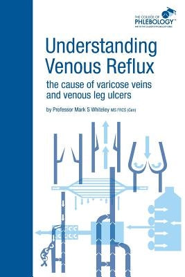 Understanding Venous Reflux the Cause of Varicose Veins and Venous Leg Ulcers: Varicose veins and venous leg ulcers Paperback Whiteley Publishing Ltd