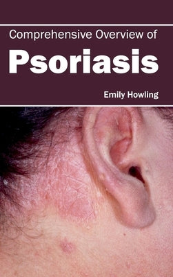Comprehensive Overview of Psoriasis by Howling, Emily