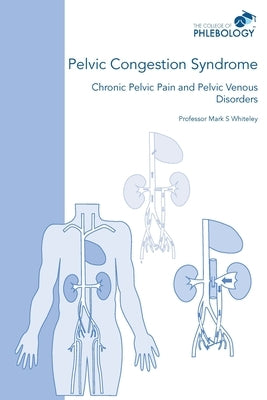 Pelvic Congestion Syndrome - Chronic Pelvic Pain and Pelvic Venous Disorders Whiteley Publishing Ltd